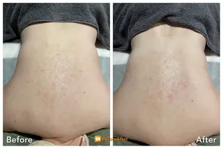 Meupニキビ専門店 背中/ハーブ/ララのその他イメージ