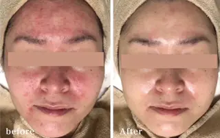 HINANO矢場町店【ヒナノ】所属・脱毛/肌改善🌿 HINANO 村田のエステ・リラクイメージ