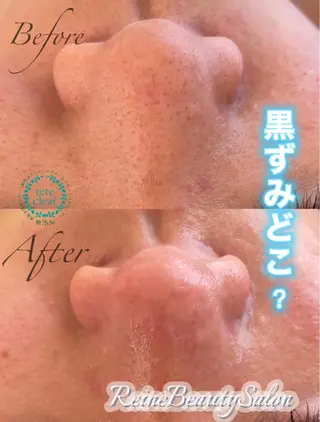 Reine BeautySalon所属・毛穴/シミ肝斑/脱毛 横山梨里のエステ・リラクイメージ