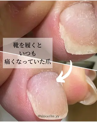ネイル 深爪・巻き爪 専門サンセリテのネイルデザイン