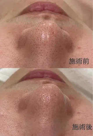 HINANO矢場町店【ヒナノ】所属・脱毛/肌改善🌿 HINANO 村田のエステ・リラクイメージ