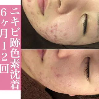 学生ニキビ改善🍀 優しい肌質改善のエステ・リラクイメージ