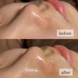 HINANO矢場町店【ヒナノ】所属・脱毛/肌改善🌿 HINANO 村田のエステ・リラクイメージ