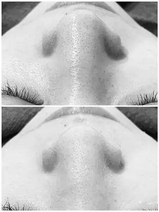 学生ニキビ改善🍀 優しい肌質改善のエステ・リラクイメージ