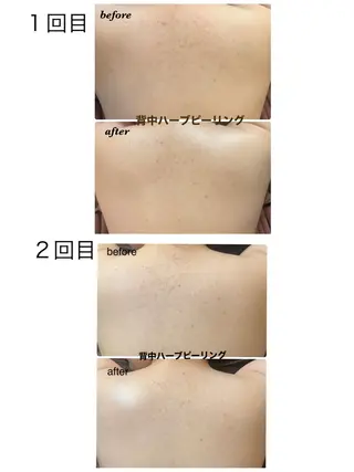 ハーブピーリング/韓国肌管理/フェイシャル/毛穴洗浄/眉毛/顔脱毛【糸脱毛専門】rev所属・肌質改善❤️美眉 脱毛🍒糸脱毛サロンのエステ・リラクイメージ