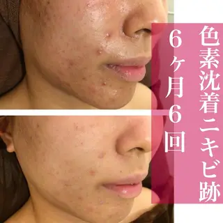 学生ニキビ改善🍀 優しい肌質改善のエステ・リラクイメージ