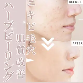 【ハーブピーリング/韓国ツヤ肌ピーリング】RelierBelle-ルリエベル-所属・肌質改善/肌育特化 プライベートサロンのエステ・リラクイメージ