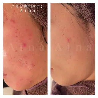 セミロング ヘアアレンジ メンズ キッズ ネイル アイブロウ ニキビ跡専門サロン Ainaのエステ・リラクイメージ