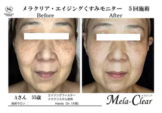 光美容シャムロック バスト、シミ専門店のエステ・リラクイメージ