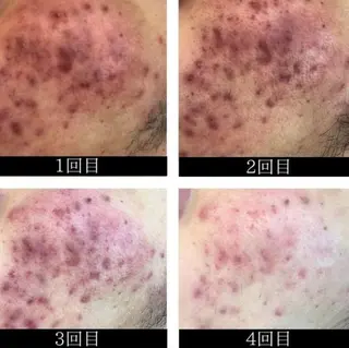 肌ケア＆毛穴洗浄 Cheriのエステ・リラクイメージ