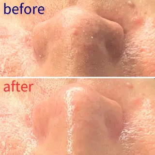 毛穴洗浄特化🫧 オオツカのエステ・リラクイメージ