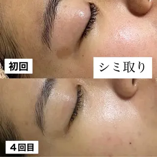 肌質改善専門サロンAte国分寺店所属・Ate Rikaのエステ・リラクイメージ