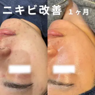 ニキビ・ニキビ跡改善 leoloのエステ・リラクイメージ