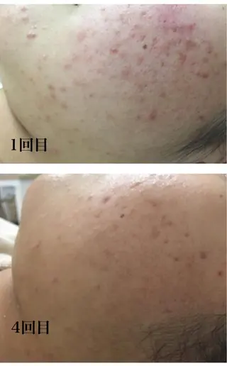 Meupニキビ専門店 背中/ハーブ/ララのその他イメージ