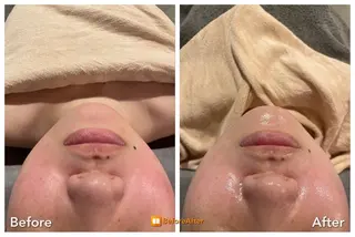 Meupニキビ専門店 背中/ハーブ/ララのその他イメージ