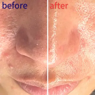 毛穴洗浄特化🫧 オオツカのエステ・リラクイメージ