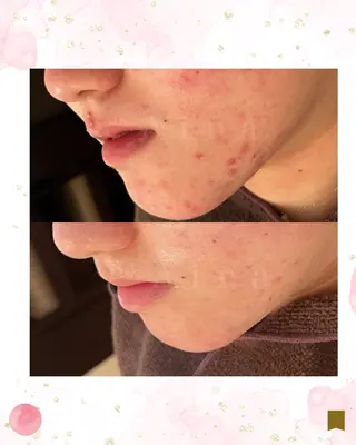 ニキビ跡専門サロン Ａｉｎａのエステ・リラクイメージ