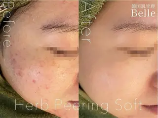 LIME横浜所属・ハーブピーリング🌿 韓国肌管理 Rionのエステ・リラクイメージ