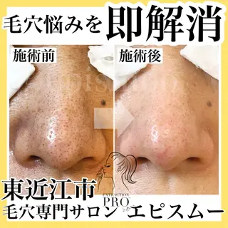 epismoo 脱毛/HBL/毛穴の眉毛・アイブロウイメージ