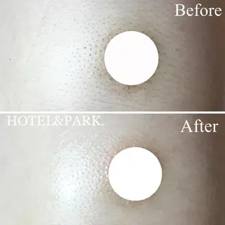 HOTEL&PARK . ワックス脱毛のエステ・リラクイメージ