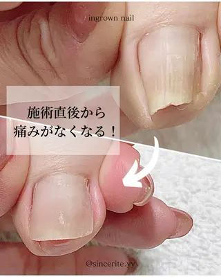 ネイル 深爪・巻き爪 専門サンセリテのネイルデザイン