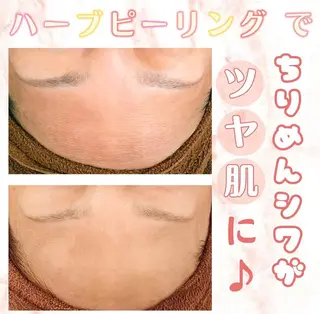 Meow！～トラブル肌専門ピーリング＆脱毛サロン～所属・トラブル肌改善🏥 Meow！🫧🫧のエステ・リラクイメージ