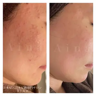 ニキビ跡専門サロン Ainaのエステ・リラクイメージ