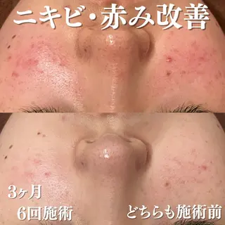 ニキビ跡改善専門🔥 医療にはできない改善のエステ・リラクイメージ