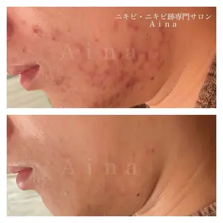 ニキビ跡専門サロン Ａｉｎａのエステ・リラクイメージ