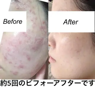 セミロング カラー パーマ ヘアアレンジ キッズ ネイル マツエク・マツパ 都度払い肌質改善 &脱毛Blancheのエステ・リラクイメージ