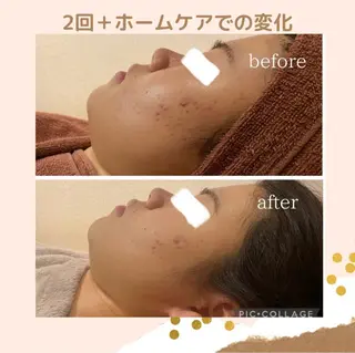 学生ニキビ改善🍀 優しい肌質改善のエステ・リラクイメージ