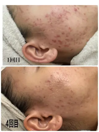 Meupニキビ専門店 背中/ハーブ/ララのその他イメージ