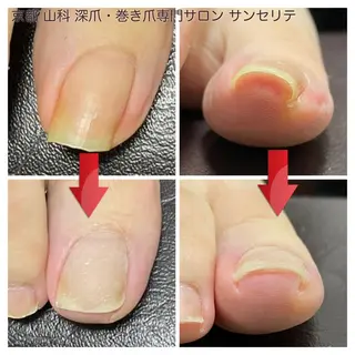ネイル 深爪・巻き爪 専門サンセリテのネイルデザイン