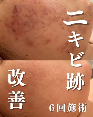 🔥3か月で肌革命 🔥ニキビ専門店のエステ・リラクイメージ