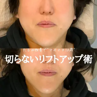 最速小顔・肌質管理 ❣️エスポワールのエステ・リラクイメージ