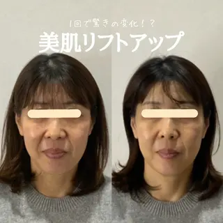 最速小顔・肌質管理 ❣️エスポワールのエステ・リラクイメージ