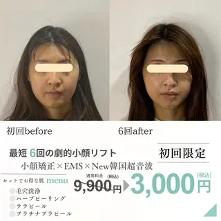 最速小顔・肌質管理 ❣️エスポワールのエステ・リラクイメージ