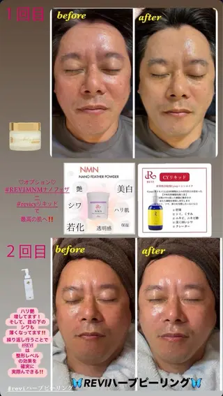 ハーブピーリング/韓国肌管理/フェイシャル/毛穴洗浄/眉毛/顔脱毛【糸脱毛専門】rev所属・肌質改善❤️美眉 脱毛🍒糸脱毛サロンのエステ・リラクイメージ