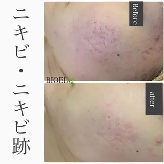 BeSkin藤沢店所属・ニキビ/肌質改善 BeSkin 藤沢店のエステ・リラクイメージ