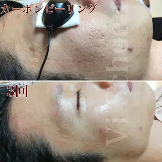 うなじ/もみあげ脱毛 ヴィシェーン佐藤のその他イメージ