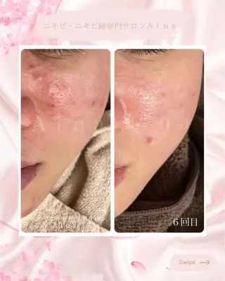 ニキビ跡専門サロン Ａｉｎａのエステ・リラクイメージ