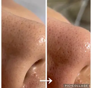 毛穴レス ハーブ＆ ワックス脱毛×光脱毛のエステ・リラクイメージ