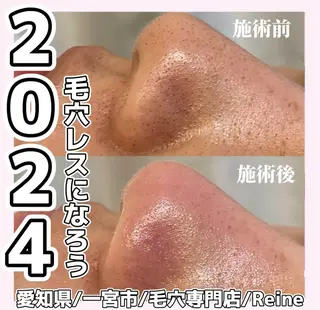 Reine BeautySalon所属・毛穴/シミ肝斑/脱毛 横山梨里のエステ・リラクイメージ