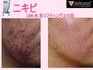 【ニキビ/肌管理】 salon varyのエステ・リラクイメージ