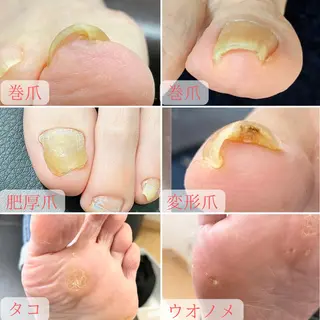 ネイル 深爪・巻き爪 専門サンセリテのネイルデザイン