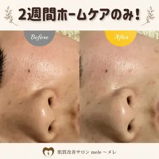 ニキビケア/毛穴/ 赤み/自信の肌✨森園のエステ・リラクイメージ