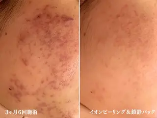 🔥3か月で肌革命 🔥ニキビ専門店のエステ・リラクイメージ