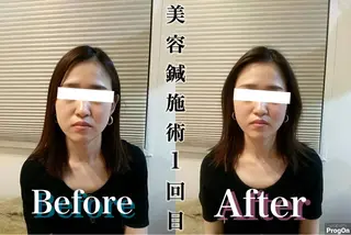 鍼灸整骨院Refine所属・鍼灸 Refineのその他イメージ