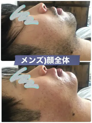 メンズ ブラジリアン☆WAX 🎖🌚YUKI🌚のエステ・リラクイメージ