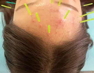 小顔美容鍼専門サロン 渋谷YZのエステ・リラクイメージ